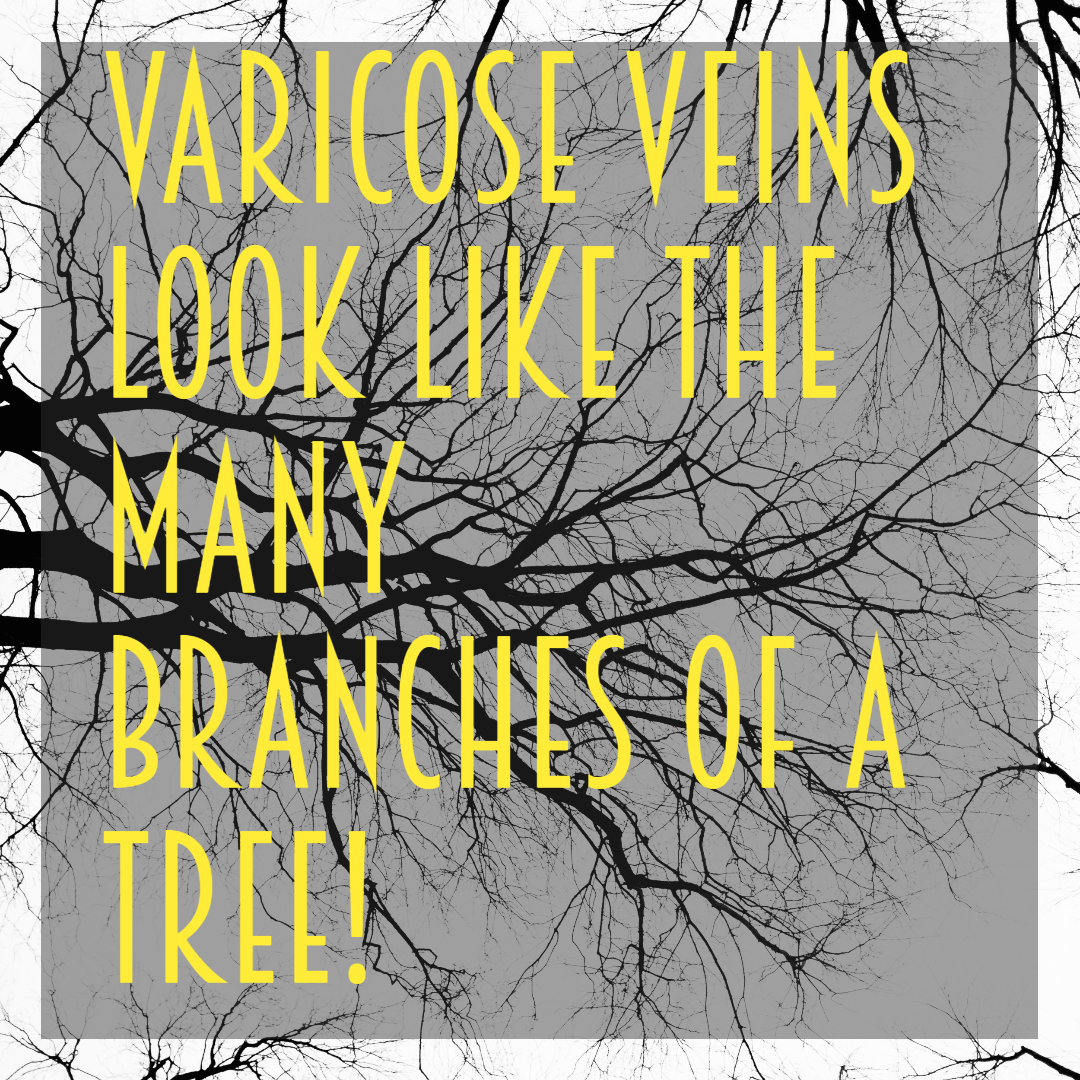 Varicose Veins Look Like Tree Branches